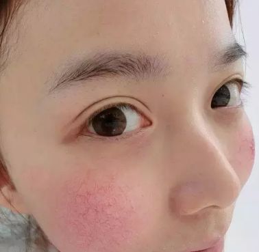 皮膚容易過敏的處理方法