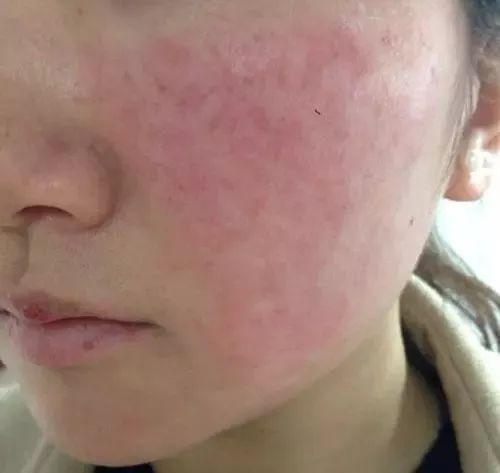 潮紅型紅血絲 紅血絲的種類有哪些?