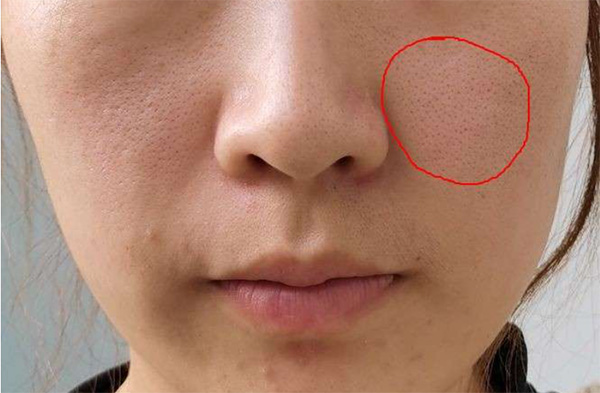 毛孔粗大 毛孔粗大如何預(yù)防?毛孔粗大預(yù)防措施
