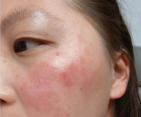 皮膚屏障受損的原因是什么？